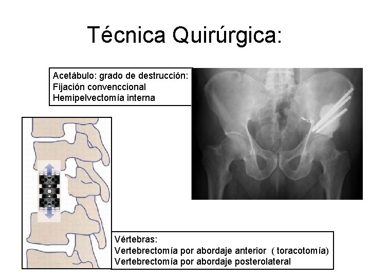 Técnica Quirúrgica: Acetábulo: grado de destrucción: Fijación convenccional Hemipelvectomía interna Vértebras: Vertebrectomía por abordaje