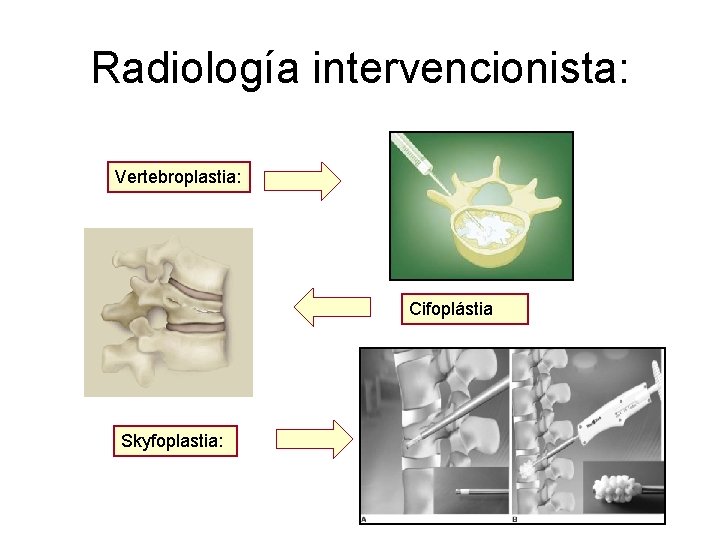 Radiología intervencionista: Vertebroplastia: Cifoplástia Skyfoplastia: 