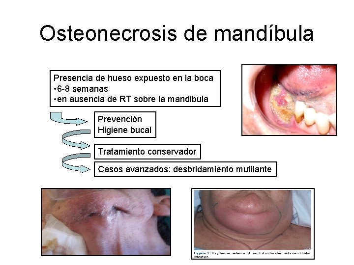 Osteonecrosis de mandíbula Presencia de hueso expuesto en la boca • 6 -8 semanas