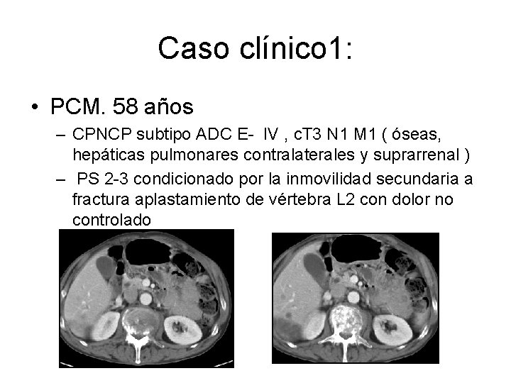 Caso clínico 1: • PCM. 58 años – CPNCP subtipo ADC E- IV ,