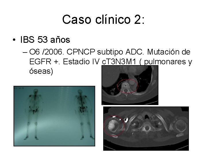 Caso clínico 2: • IBS 53 años – O 6 /2006. CPNCP subtipo ADC.
