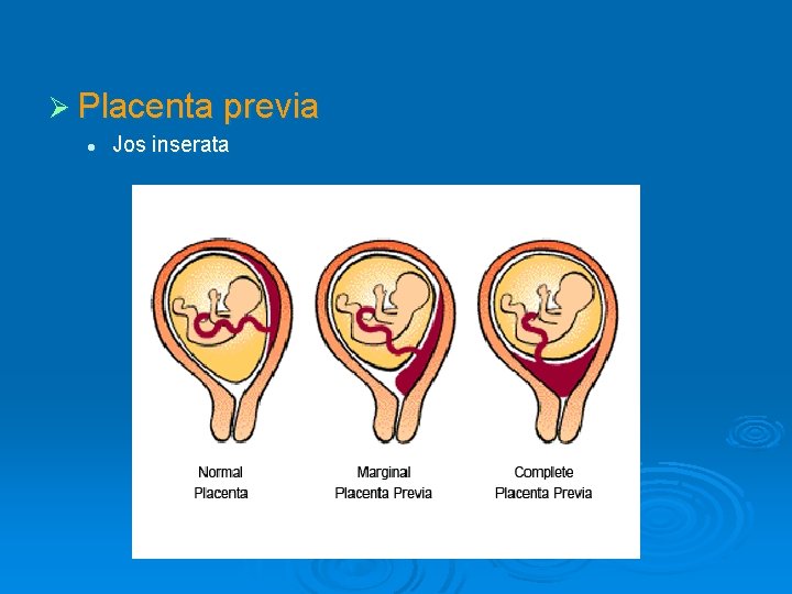 Ø Placenta previa l Jos inserata 