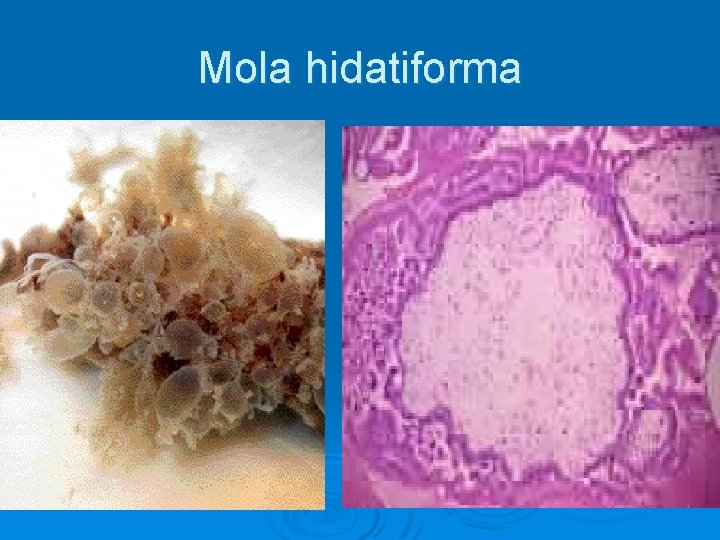 Mola hidatiforma 