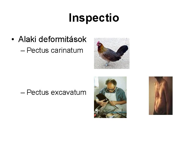 Inspectio • Alaki deformitások – Pectus carinatum – Pectus excavatum 