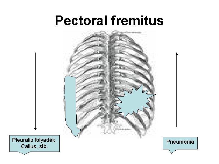 Pectoral fremitus Pleuralis folyadék, Callus, stb. Pneumonia 