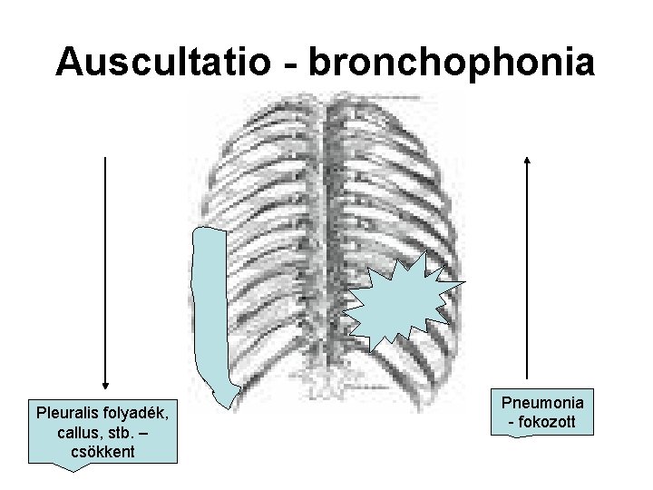 Auscultatio - bronchophonia Pleuralis folyadék, callus, stb. – csökkent Pneumonia - fokozott 