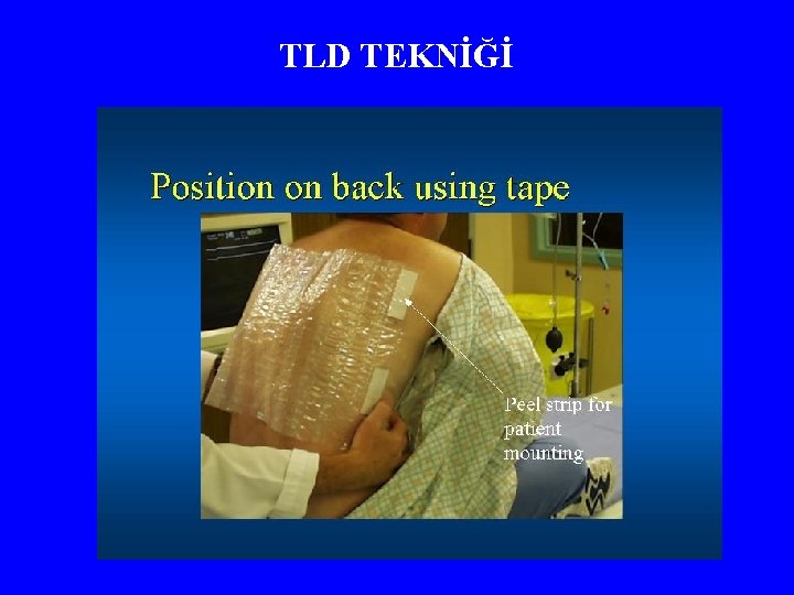 TLD TEKNİĞİ 