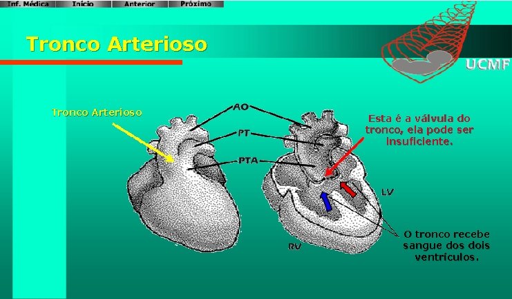 Tronco Arterioso Esta é a válvula do tronco, ela pode ser insuficiente. O tronco