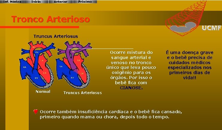 Tronco Arterioso Truncus Arteriosus Normal Ocorre mistura do sangue arterial e venoso no tronco
