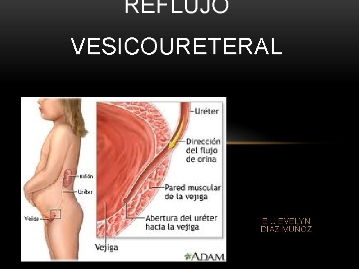 REFLUJO VESICOURETERAL E. U EVELYN DIAZ MUÑOZ REFLUJO VESICOURETERAL E. U EVELYN DIAZ MUÑOZ