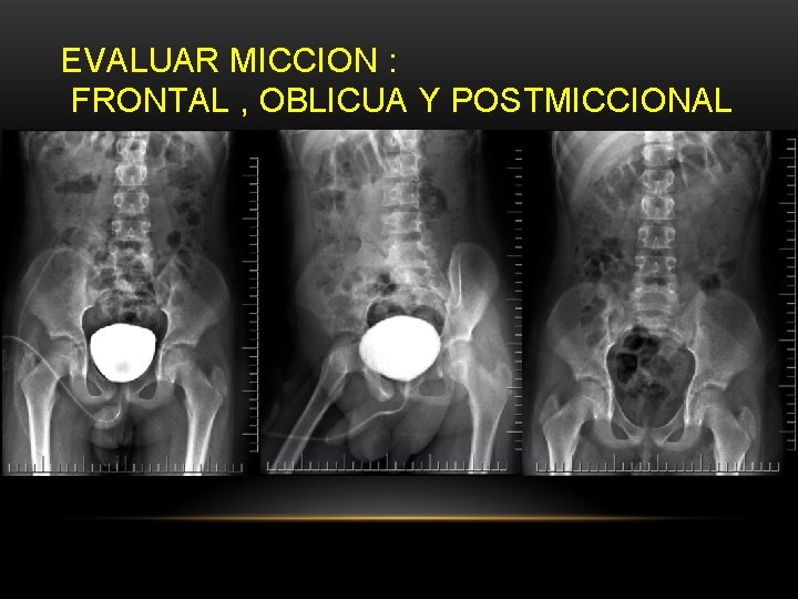 EVALUAR MICCION : FRONTAL , OBLICUA Y POSTMICCIONAL EVALUAR MICCION : FRONTAL , OBLICUA Y POSTMICCIONAL