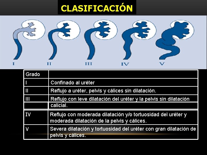 CLASIFICACIÓN Grado I Confinado al uréter II Reflujo a uréter, pelvis y cálices sin CLASIFICACIÓN Grado I Confinado al uréter II Reflujo a uréter, pelvis y cálices sin