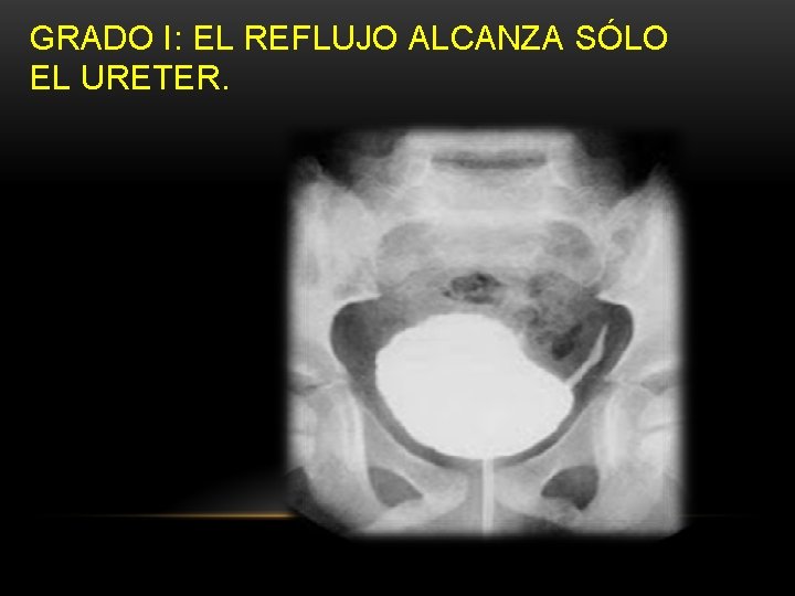 GRADO I: EL REFLUJO ALCANZA SÓLO EL URETER. GRADO I: EL REFLUJO ALCANZA SÓLO EL URETER.