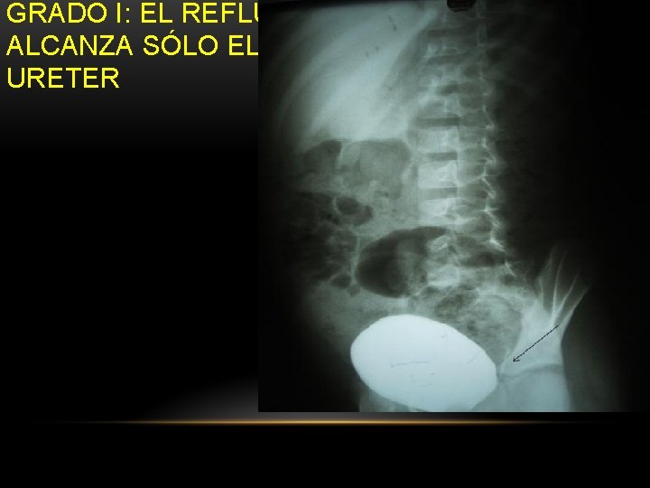 GRADO I: EL REFLUJO ALCANZA SÓLO EL URETER GRADO I: EL REFLUJO ALCANZA SÓLO EL URETER