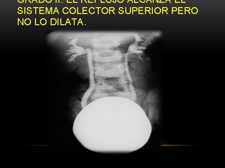 GRADO II: EL REFLUJO ALCANZA EL SISTEMA COLECTOR SUPERIOR PERO NO LO DILATA. GRADO II: EL REFLUJO ALCANZA EL SISTEMA COLECTOR SUPERIOR PERO NO LO DILATA.
