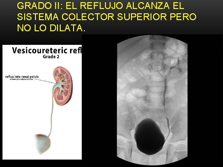 GRADO II: EL REFLUJO ALCANZA EL SISTEMA COLECTOR SUPERIOR PERO NO LO DILATA. GRADO II: EL REFLUJO ALCANZA EL SISTEMA COLECTOR SUPERIOR PERO NO LO DILATA.