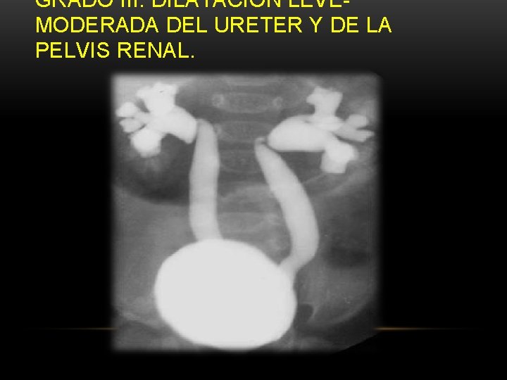 GRADO III: DILATACIÓN LEVEMODERADA DEL URETER Y DE LA PELVIS RENAL. GRADO III: DILATACIÓN LEVEMODERADA DEL URETER Y DE LA PELVIS RENAL.