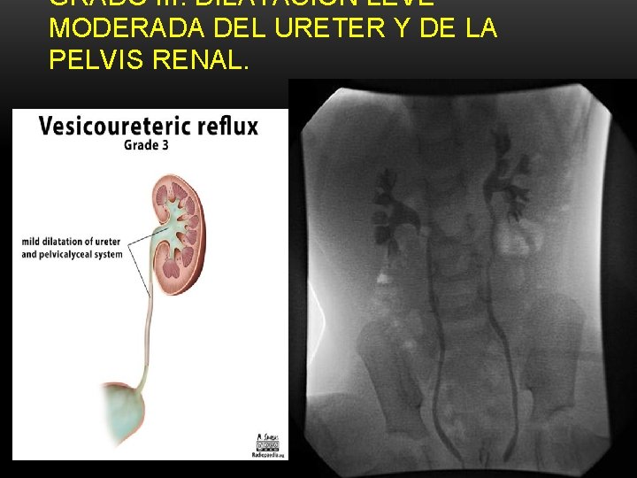 GRADO III: DILATACIÓN LEVEMODERADA DEL URETER Y DE LA PELVIS RENAL. GRADO III: DILATACIÓN LEVEMODERADA DEL URETER Y DE LA PELVIS RENAL.