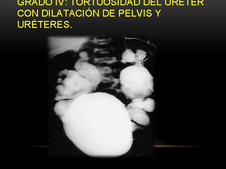 GRADO IV: TORTUOSIDAD DEL URETER CON DILATACIÓN DE PELVIS Y URÉTERES. GRADO IV: TORTUOSIDAD DEL URETER CON DILATACIÓN DE PELVIS Y URÉTERES.