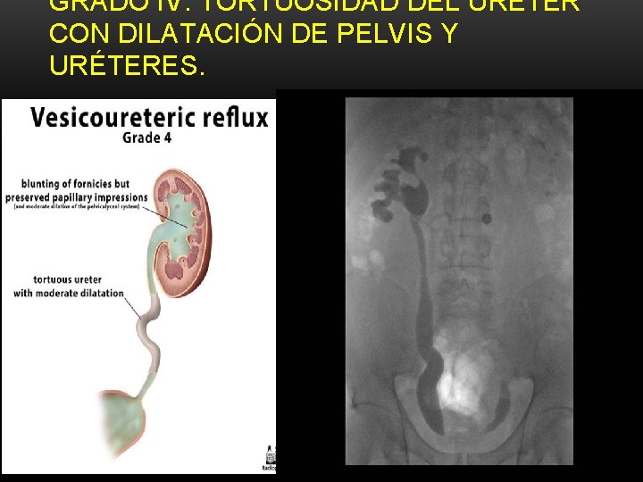 GRADO IV: TORTUOSIDAD DEL URETER CON DILATACIÓN DE PELVIS Y URÉTERES. GRADO IV: TORTUOSIDAD DEL URETER CON DILATACIÓN DE PELVIS Y URÉTERES.