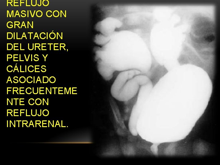 REFLUJO MASIVO CON GRAN DILATACIÓN DEL URETER, PELVIS Y CÁLICES ASOCIADO FRECUENTEME NTE CON REFLUJO MASIVO CON GRAN DILATACIÓN DEL URETER, PELVIS Y CÁLICES ASOCIADO FRECUENTEME NTE CON