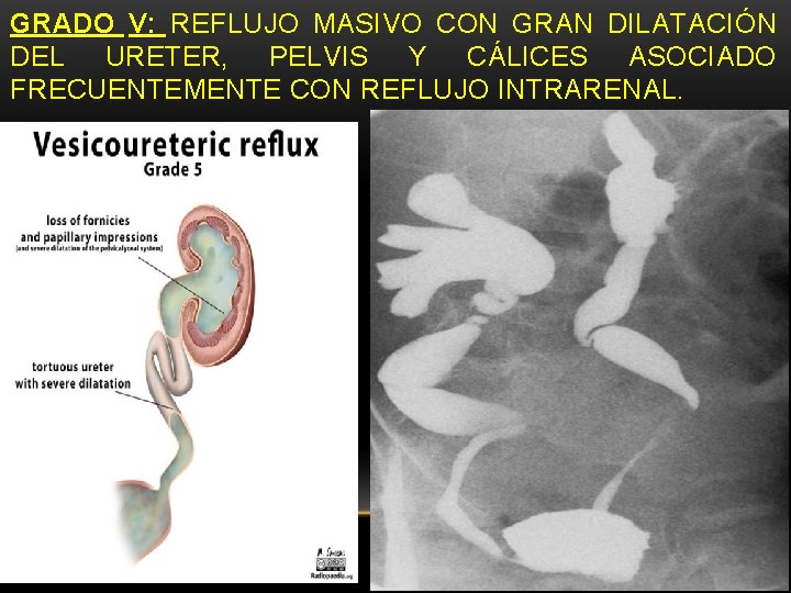 GRADO V: REFLUJO MASIVO CON GRAN DILATACIÓN DEL URETER, PELVIS Y CÁLICES ASOCIADO FRECUENTEMENTE GRADO V: REFLUJO MASIVO CON GRAN DILATACIÓN DEL URETER, PELVIS Y CÁLICES ASOCIADO FRECUENTEMENTE