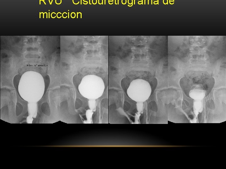 RVU Cistouretrograma de micccion RVU Cistouretrograma de micccion