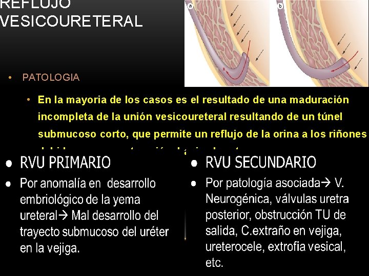 REFLUJO VESICOURETERAL • PATOLOGIA • En la mayoria de los casos es el resultado REFLUJO VESICOURETERAL • PATOLOGIA • En la mayoria de los casos es el resultado