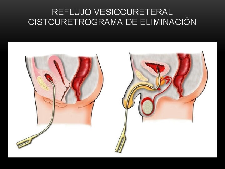 REFLUJO VESICOURETERAL CISTOURETROGRAMA DE ELIMINACIÓN REFLUJO VESICOURETERAL CISTOURETROGRAMA DE ELIMINACIÓN