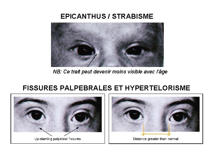 EPICANTHUS / STRABISME NB: Ce trait peut devenir moins visible avec l’âge FISSURES PALPEBRALES