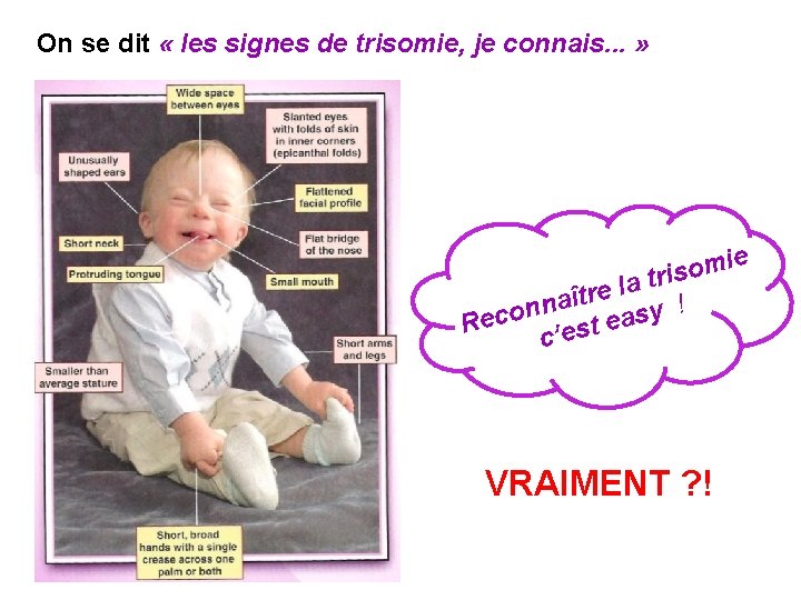 On se dit « les signes de trisomie, je connais. . . » e