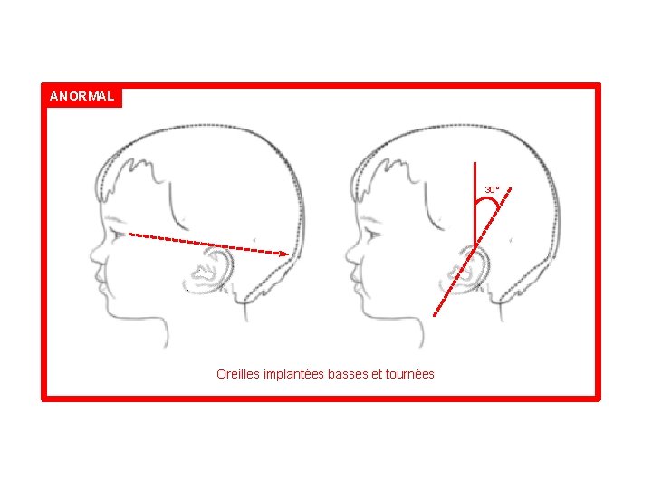 ANORMAL 30° Oreilles implantées basses et tournées 