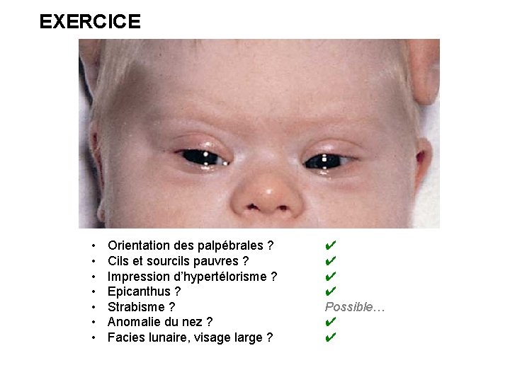 EXERCICE • • Orientation des palpébrales ? Cils et sourcils pauvres ? Impression d’hypertélorisme