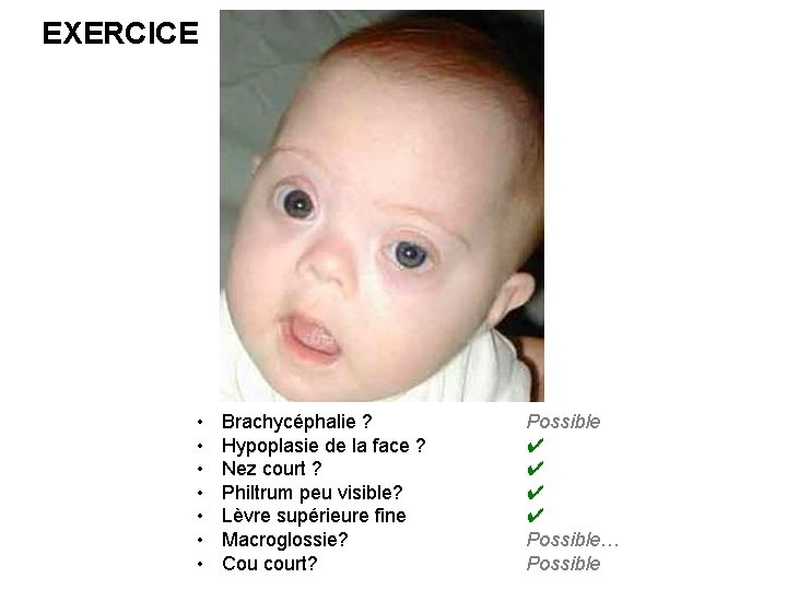 EXERCICE • • Brachycéphalie ? Hypoplasie de la face ? Nez court ? Philtrum
