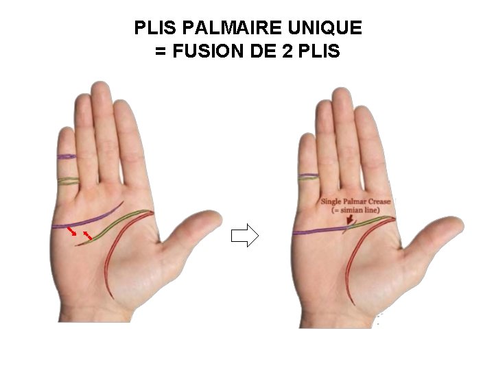 PLIS PALMAIRE UNIQUE = FUSION DE 2 PLIS 