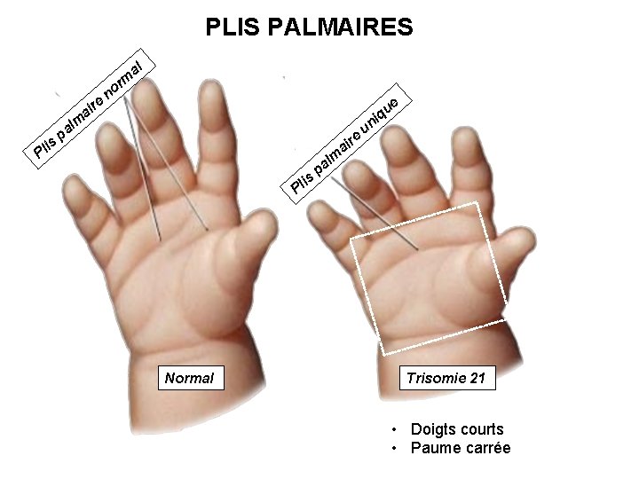 PLIS PALMAIRES al re ai m or n e m al p n is
