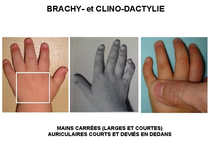 BRACHY- et CLINO-DACTYLIE MAINS CARRÉES (LARGES ET COURTES) AURICULAIRES COURTS ET DEVIÉS EN DEDANS