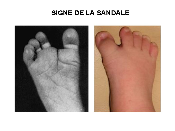 SIGNE DE LA SANDALE 