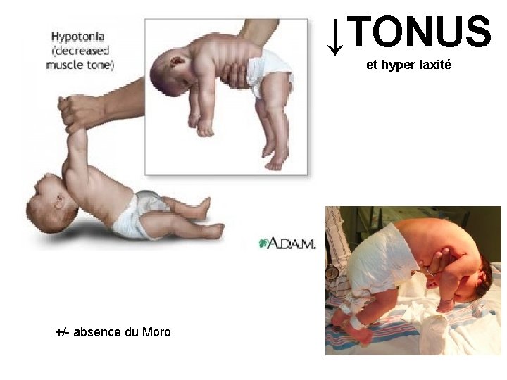 ↓TONUS et hyper laxité +/- absence du Moro 