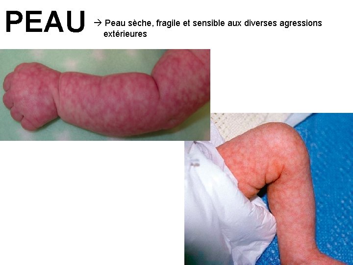 PEAU Peau sèche, fragile et sensible aux diverses agressions extérieures 