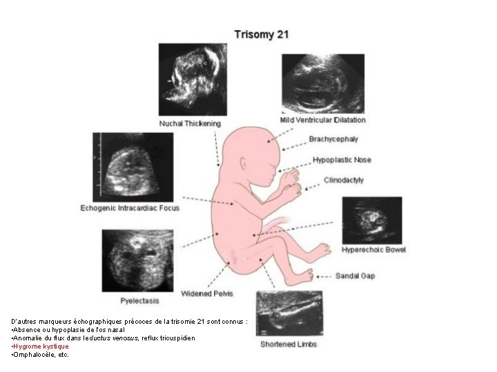 D’autres marqueurs échographiques précoces de la trisomie 21 sont connus : • Absence ou