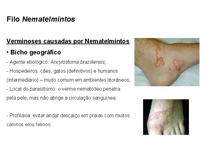 Filo Nematelmintos Verminoses causadas por Nematelmintos • Bicho geográfico - Agente etiológico: Ancylostoma braziliensis;