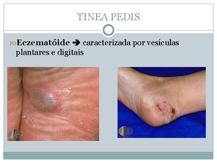TINEA PEDIS Eczematóide caracterizada por vesículas plantares e digitais 
