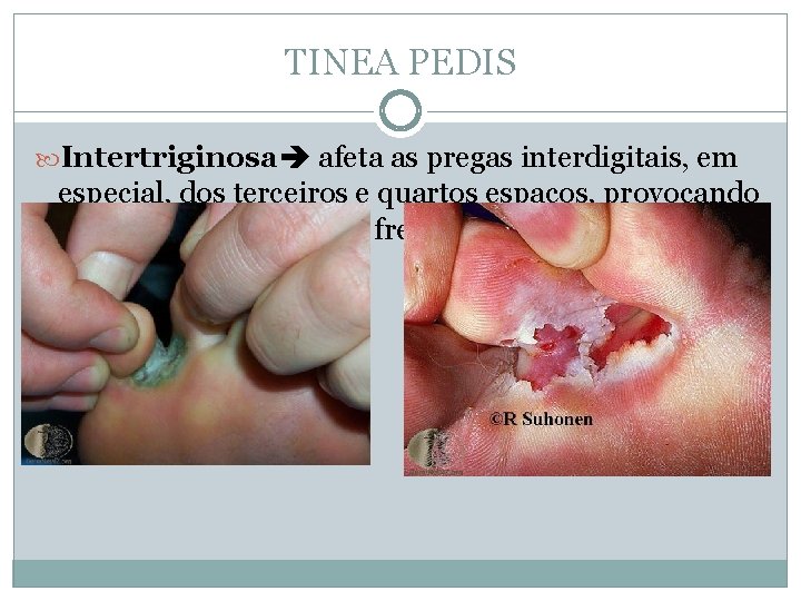 TINEA PEDIS Intertriginosa afeta as pregas interdigitais, em especial, dos terceiros e quartos espaços,