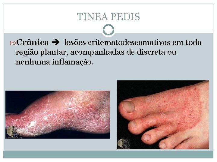 TINEA PEDIS Crônica lesões eritematodescamativas em toda região plantar, acompanhadas de discreta ou nenhuma