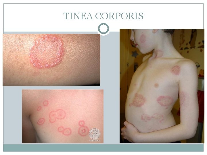 TINEA CORPORIS 