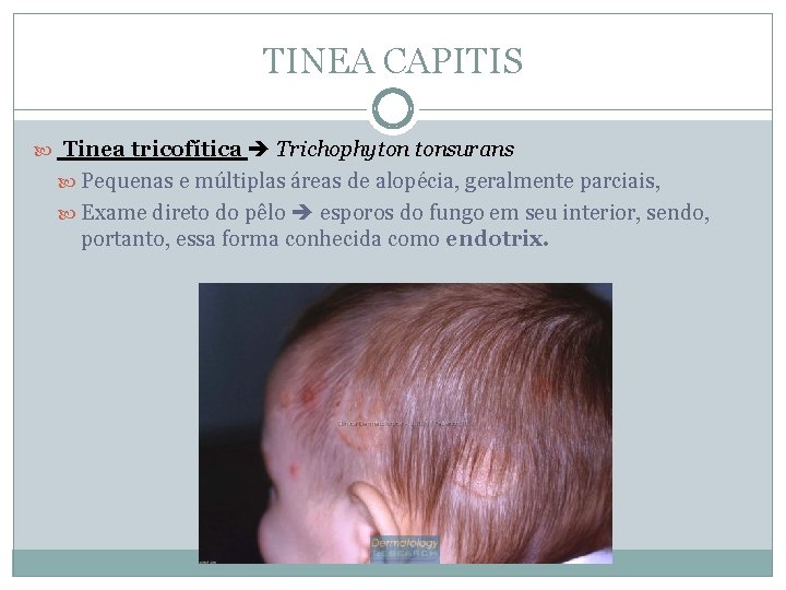 TINEA CAPITIS Tinea tricofítica Trichophyton tonsurans Pequenas e múltiplas áreas de alopécia, geralmente parciais,