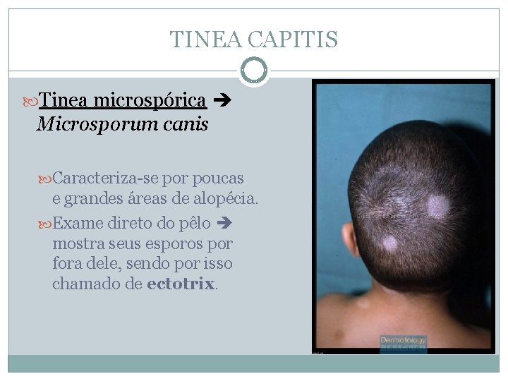 TINEA CAPITIS Tinea microspórica Microsporum canis Caracteriza-se por poucas e grandes áreas de alopécia.