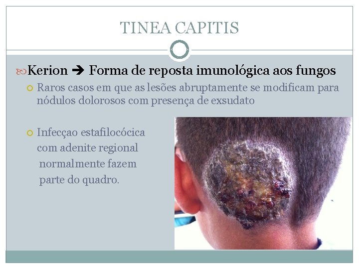 TINEA CAPITIS Kerion Forma de reposta imunológica aos fungos Raros casos em que as