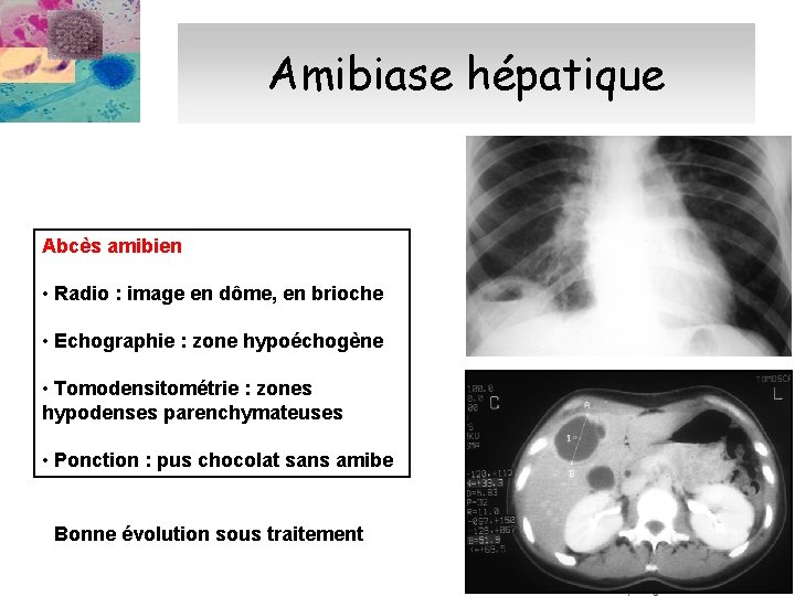 Amibiase hépatique Abcès amibien • Radio : image en dôme, en brioche • Echographie